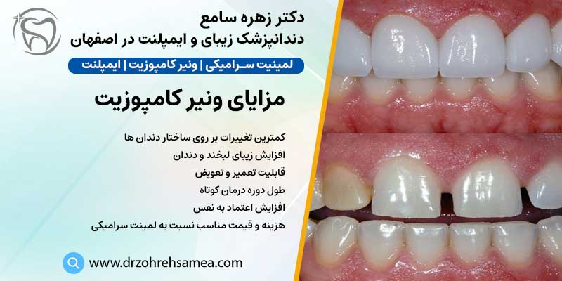 مزایای کامپوزیت دندان | دکتر زهره سامع دندانپزشک زیبایی و ایمپلنت