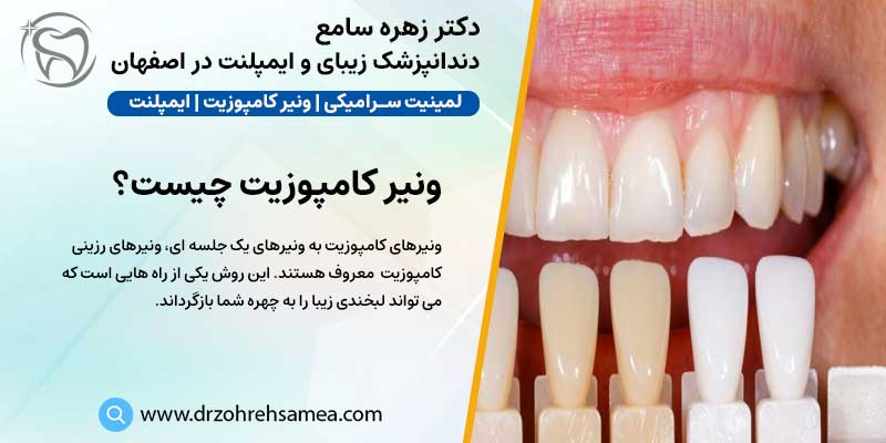ونیر کامپوزیت در اصفهان | دکتر زهره سامع دندانپزشک ایمپلنت و زیبایی