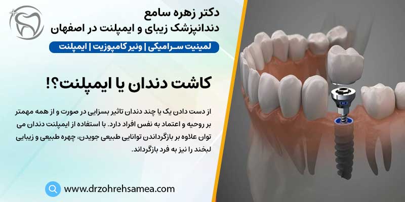 کاشت دندان در اصفهان | دکتر زهره سامع متخصص ایمپلنت و دندانپزشک زیبایی در اصفهان