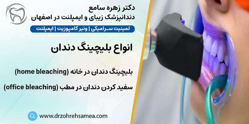 انواع بلیچینگ دندان | دکتر زهره سامع دندانپزشک زیبایی و ایمپلنت در اصفهان