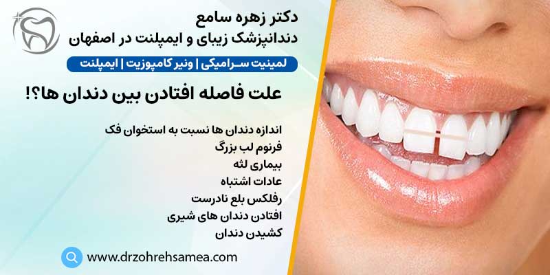 علت فاصله افتادن بین دندان ها | دکتر زهره سامع دندانپزشک زیبایی در اصفهان